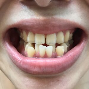 矯正前の歯